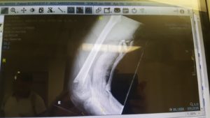 Fracture x-ray